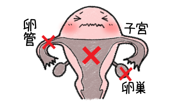 子宮卵管卵巣の病